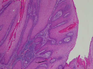 Epitelio escamoso no invasivo. Tinción eosina-hematoxilina 40x.