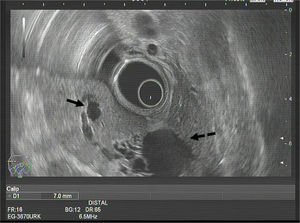 Imagen de la sonoendoscopia que muestra un calibre normal de la vía biliar principal (flecha continua) y una dilatación de la vía biliar izquierda con lesiones quísticas intrahepáticas (flecha discontinua).