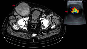 A) Imagen de angio-TAC con dilatación aneurismática iliofemoral derecha con zonas periféricas compatibles con sangrado arterial agudo. B) Imagen de ecografía Doppler compatible con seudoaneurisma permeable.