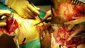 A) Control arterial proximal ilíaco vía retroperitoneal. B) Seudoaneurisma para-anastomótico femoral derecho. C) Resección de seudoaneurisma con exposición de bypass iliofemoral derecho previo.