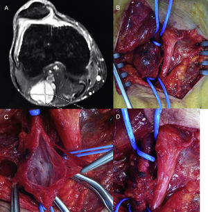 A) Detalle del aneurisma venoso poplíteo en la angio-RMN. B) Imagen intraoperatoria del aneurisma venoso. C) Detalle del aneurisma venoso abierto. D) Resultado tras la aneurismectomía tangencial del mismo con venorrafia lateral.