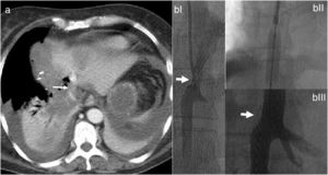 a) La tomografía computarizada con contraste intravenoso evidencia la dislocación del remanente hepático (la flecha señala giro de vena suprahepática izquierda); b) Venografía de estenosis a nivel de suprahepática izquierda (a). Colocación de stent (b). Resultado luego de la dilatación y la colocación del stent (c).