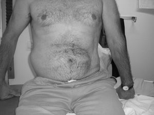 Seudohernia abdominal derecha tras una lesión medular D12 asimétrica.