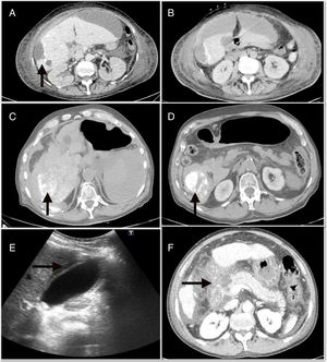 A)absceso hepático posquimioembolización. B)Colección perihepática subcapsular que se continúa con la lesión periférica del segmento 6. C)Hemoperitoneo que ocupa predominantemente el flanco derecho. D)Focos de lipiodol extravasado hacia la cavidad abdominal. E)Ecografía abdominal con signos de colecistitis aguda. F)Necrosis extensa de la cabeza pancreática asociada a necrosis de la grasa peripancreática y de la raíz del mesenterio.