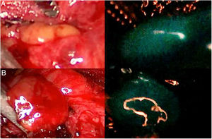 Dos glándulas paratiroides (A y B) que se muestran claramente autofluorescentes al iluminarse con luz del espectro NIR (imágenes de la derecha), con el dispositivo Image 1HD de Karl Storz®, sin que se haya administrado ningún trazador fluorescente exógeno.