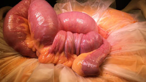 Tomografía axial del abdomen donde se muestra la invaginación causante de la oclusión intestinal (izquierda, flecha) y la presencia de otros implantes tumorales (izquierda, asterisco). Foto derecha, control a los 12 meses de la cirugía donde se observa la desaparición de las lesiones intestinales de metástasis de melanoma.