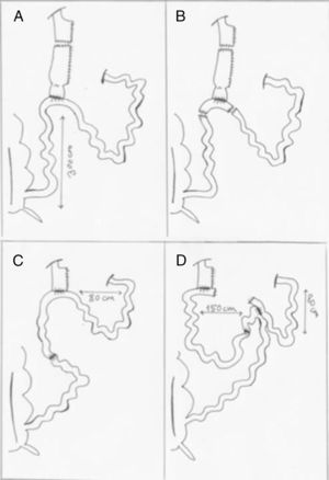A) Creación de reservorio gástrico de 60cc con grapadora lineal. B) Resección en Y invertida del remanente gástrico e íleon, incluyendo la anastomosis con el punto de fuga. C) Realización de anastomosis íleo-ileal y gastroyeyunal mecánicas, con asa biliopancreática de 80cm de longitud. D) Creación de un asa alimentaria de 150cm y finalmente sección de la comunicación del asa biliopancreática con la anastomosis gastroyeyunal.