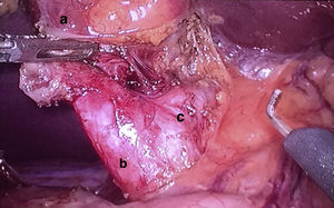 Imagen intraoperatoria donde se aprecia el quiste del conducto cístico entre la vesícula y la vía biliar principal: a: vesícula biliar; b: quiste del conducto cístico; c: vía biliar principal.