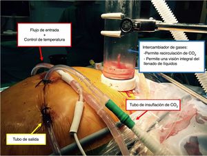 Sistema de circuito cerrado + flujo turbulento para HIPEC.