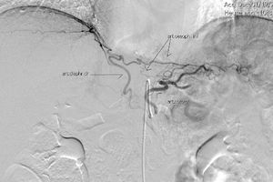 Arteriografía del tronco celiaco donde se aprecia la vascularización de la unión esofagogástrica.