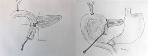 Detalle técnico de la anastomosis ducto-yeyunal tutorizada externamente sobre asa aferente según la técnica de Witzel.