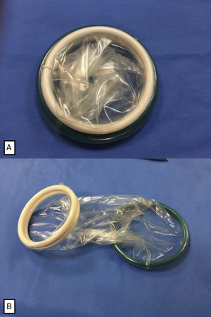 A) Dispositivo retractor Alexis® tamaño XS (4cm de diámetro). Formado por 2 anillos flexibles unidos por una membrana de polímero. B) Dispositivo retractor Alexis® desdoblado, antes de su colocación.