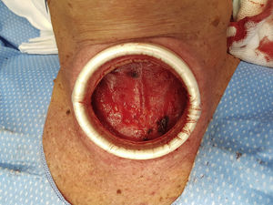 Retractor Alexis® colocado en la incisión, exponiendo la fascia cervical superficial y la musculatura prelaríngea.