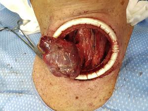 Fotografía durante una loboistmectomía derecha en la que se observa el hemitiroides derecho pediculado al istmo.