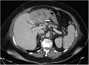 Paciente 2. TAC poscolecistectomía laparoscópica. Se muestra claramente un absceso hepático en el segmento iii con una imagen lineal de alta densidad que se comunicó con el área del absceso hepático (flecha). También se puede ver un endoclip (círculo).