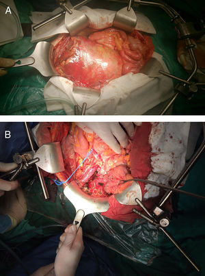A) Masa en localización preperitoneal. B) Vena y arteria iliaca externa derecha y uréter tras la disección.