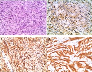 Secciones histológicas que muestran características típicas de perineurioma y schwannoma: a) H&E ×100; b) análisis inmunohistoquímico positivo para AME (×100); c) análisis inmunohistoquímico positivo para Glut-1 (×200); d) análisis inmunohistoquímico positivo para S100 (×200).