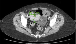 Tumoración intestinal e invaginación secundaria.
