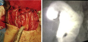 Anastomosis faringo-yeyunal y traqueostomía terminal. Imagen de angiografía con fluorescencia con ICG que corresponde a plastia ileocólica en su posición definitiva previa anastomosis.
