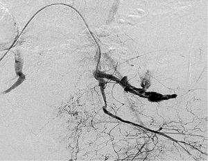 Arteriografía: extravasación de contraste en arteria hipográstrica > izquierda.