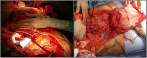 Canulación de las arterias ilíacas externas (no es preciso canular las venas) y preparación del injerto para su extracción.