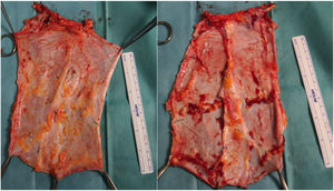 Ejemplos de injertos de fascia no vascularizada.