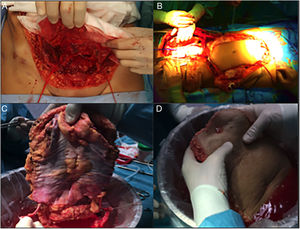 Fases de la extracción de injerto completo. A) Disección de los vasos epigástricos inferiores. B) Preparación de cánulas con el colgajo «en casa». C) Disección en banco de la arcada vascular epigástrica inferior. D) Comprobación de perfusión.