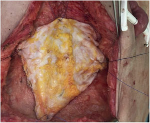 Detalle de la colocación definitiva del injerto de fascia no vascularizada.