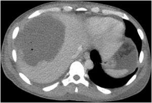 TC abdominal que muestra el tamaño del absceso hepático (130×95mm) ocupando casi la totalidad del hígado derecho antes de la primera intervención quirúrgica realizada.