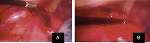 Imagen de la videotoracoscopia. A) Objeto cortopunzante de unos 15cm enclavado en tórax izquierdo penetrando por la horquilla esternal inmediatamente medial a la salida de la arteria subclavia. B) Hemotórax coagulado de unos 500cm3.