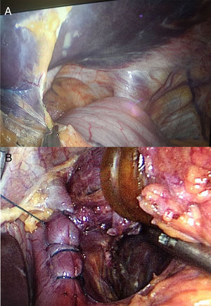 A) Hallazgo intraoperatorio. Hernia hiatal gigante. B) El defecto herniario se cerró mediante sutura barbada continua.