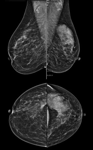 Mamografía que muestra masa nodular en el cuadrante superoexterno de la mama izquierda, parcialmente bien delimitado y categorizado como BIRADS IVa.