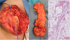 Lesión de partes blandas compatible con fibrolipoma. Disección triángulo Scarpa (nervio femoral referenciado en azul/safena interna seccionada en rojo). Estudio histológico que muestra los adipocitos atravesados por bandas de tejido fibroso (H&E ×20).