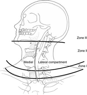 Zonas anatómicas del cuello. Fuente: Monson et al.69.