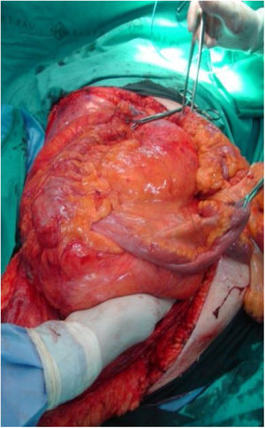 Exéresis en bloque de liposarcoma retroperitoneal desdiferenciado derecho.