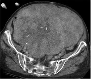 Gran sarcoma pélvico con compresión, pero sin invasión de todos los órganos de la pelvis.