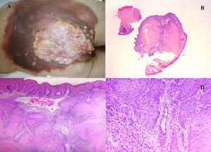 A) Imagen de la lesión perineal, glútea bilateral y sacra con zonas supurativas y áreas sospechosas de infiltración tumoral. B) Lesión escamosa bien diferenciada endofítica (H&E ×4). C) Nidos de células escamosas con citoplasma densamente eosinofílico (H&E ×40). D) Interfase estroma-epitelio (H&E ×200).