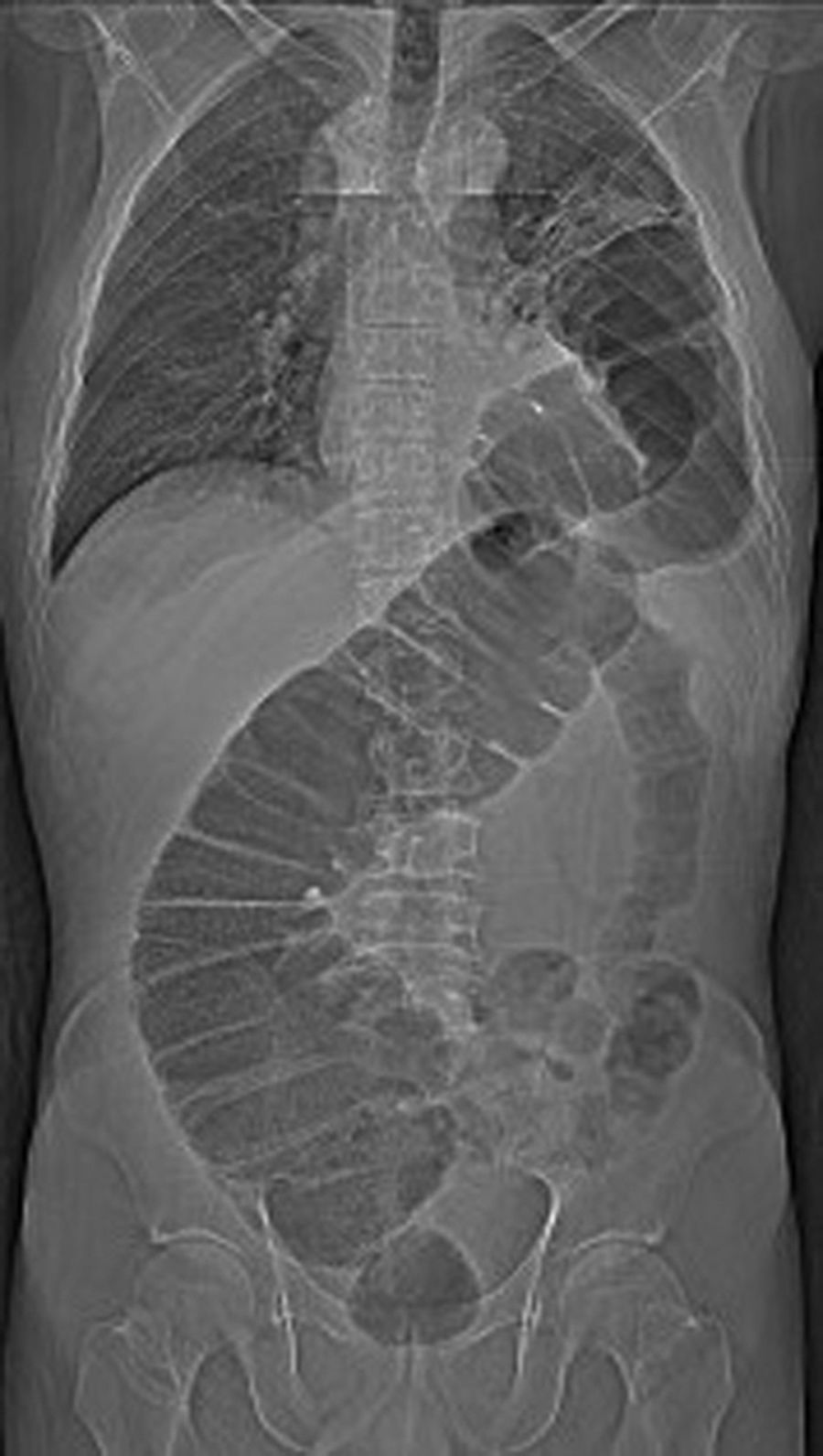 Herniación transhiatal del colon postesofagectomía | Cirugía Española