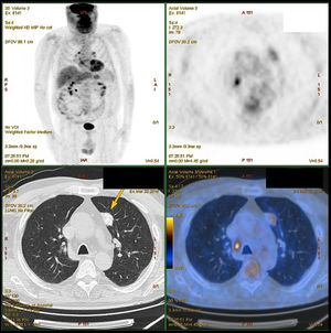 PET/TC torácico que muestra lesión hipermetabólica pulmonar (SUVmáx 2,7g/ml) sugiriendo malignidad; siendo un nódulo amiloideo. Ganglio de tamaño borderline, pero hipermetabólico en espacio paratraqueal derecho (14×8mm) con SUVmáx 6,3g/ml.