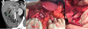 Imágenes correspondientes al caso 2. A) Angio-TC abdominal previo a cirugía. Corte coronal en el que se observa la lesión pancreática. 1: confluente mesentérico-portal, 2: tumor pancreático. B) Injerto vascular ya posicionado previo al desclampaje. 1: vena porta, 2: injerto tubular de recto abdominal, 3: vena mesentérica superior. C) Injerto definitivo.