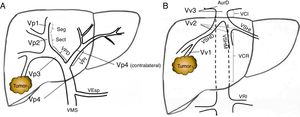 Clasificación del nivel de trombosis tumoral portal (A) y del sistema venoso suprahepático/cava (B) según la nomenclatura japonesa. A: Vp1, presencia de trombo tumoral en ramas segmentarias (Seg) o subsegmentarias; Vp2, trombo tumoral en las ramas portales de segundo orden (sectoriales, Sect); Vp3, trombo tumoral en las ramas de primer orden (vena porta derecha o vena porta izquierda); Vp4, trombo tumoral en el tronco portal principal y/o en el sistema portal contralateral al lóbulo afectado. B: Vv1, presencia de trombo tumoral en ramas venosas hepáticas periféricas, incluyendo la invasión microvascular; Vv2, trombo tumoral en ramas venosas suprahepáticas principales; Vv3, trombo tumoral en vena cava inferior. AurD: aurícula derecha; VCI: vena cava inferior; VCR: vena cava retrohepática; VEsp: vena esplénica; VMS: vena mesentérica superior; VPD: vena porta derecha; VPI: vena porta izquierda; VRI: vena renal izquierda; VSHD: vena suprahepática derecha; VSHI: vena suprahepática izquierda; VSHM: vena suprahepática media.