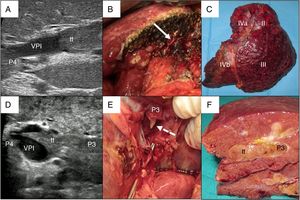 Ejemplos de hepatectomía izquierda en bloque (caso 1, A-C) y sectorectomía lateral con técnica del peeling off (caso 2, D-F). Caso 1. A: La ecografía intraoperatoria del sector lateral muestra el frente del trombo tumoral (tt) procedente de la rama portal del segmentoII, que penetra parcialmente hacia la luz de la vena porta izquierda (VPI), dejando libre las ramas portales del segmentoIV (P4). B: Con un remanente hepático adecuado, se ejecuta resección en bloque (muñón vena porta izquierda señalado con flecha). C: Hepatectomía izquierda (segmentosII-III-IV). Caso 2. D: En este otro caso, la ecografía intraoperatoria del sector lateral muestra el trombo tumoral (tt) que, desde el segmentoIII, atraviesa completamente la luz de la vena porta izquierda (VPI) hasta introducirse en la rama portal del segmentoIV (P4). E: Dado el volumen remanente insuficiente para realizar una hepatectomía izquierda, la técnica del peeling off permite retranquear el frente del trombo tumoral a través de una venotomía en el sector umbilical de la VPI. La flecha discontinua señala el tt asomándose a través de P3 (vena porta del segmentoIII). F: Pieza de sectorectomía lateral tallada, con trombo tumoral (tt) ocupando completamente la luz portal.