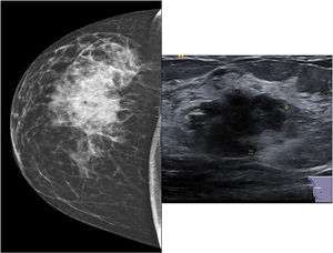 Mamografía que muestra masa en cuadrante superoexterno de mama derecha. A la derecha ecografía que muestra la lesión categorizada como BIRADS IVb.