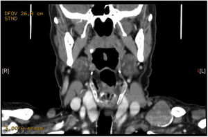 TAC que muestra una lesión supraclavicular cervical posterior izquierda.