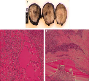Anatomía patológica: A) Se observa una formación ovoidea correspondiente a una tumoración mesenquimal multinodular seudoencapsulada. B y C) Se identifican algunos focos de aspecto mixoide compatible con tumor fibromixoide osificante maligno.