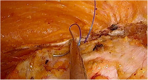 Sutura de los márgenes mediales de las vainas anteriores musculares.