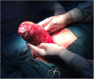 Gran tumoración inguinal englobando saco herniario y testículo.