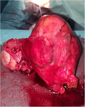 Pieza quirúrgica: tumoración de saco herniario y testículo izquierdo.
