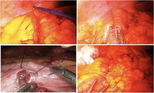 Uso de la sutura barbada en hemicolectomía derecha laparoscópica.