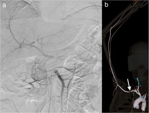 a) Arteriografía diagnóstica de trombosis de tronco celíaco. b) Reconstrucción 3D de angio-TAC mostrando estenosis de subclavia derecha (flecha blanca).